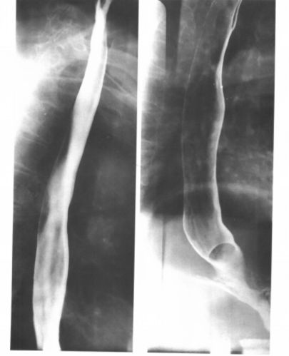 食管疾病的X线造影