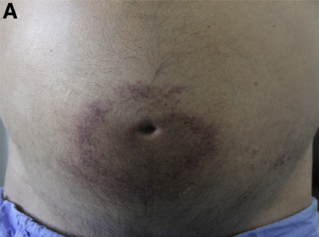 Cullen（卡伦）征是什么