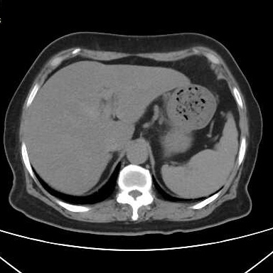 胃结石的2个病例