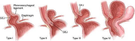 什么是食管裂孔疝