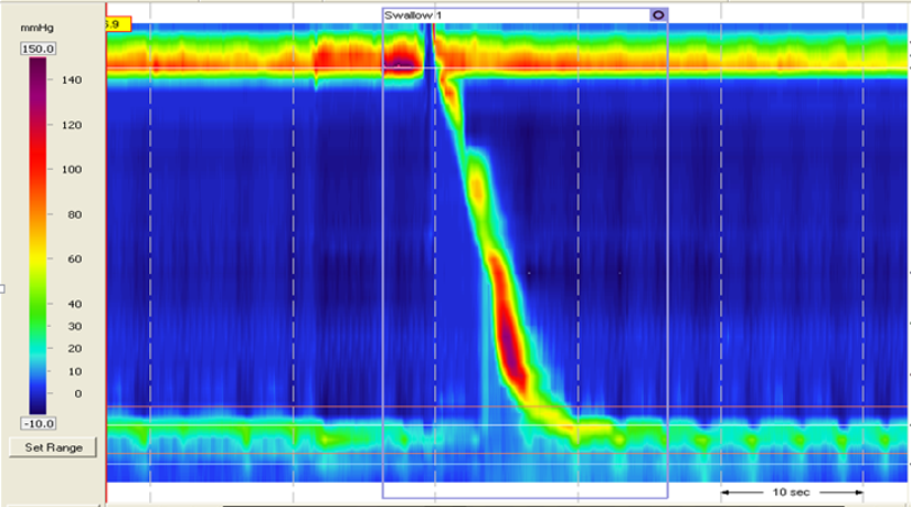 高分辨率食管测压怎么做