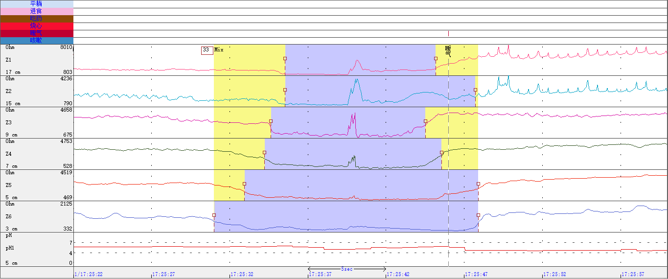 食道阻抗-ph联合监测之反流致咳嗽
