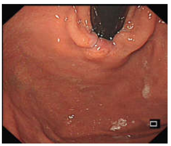 贲门松弛，hill分级