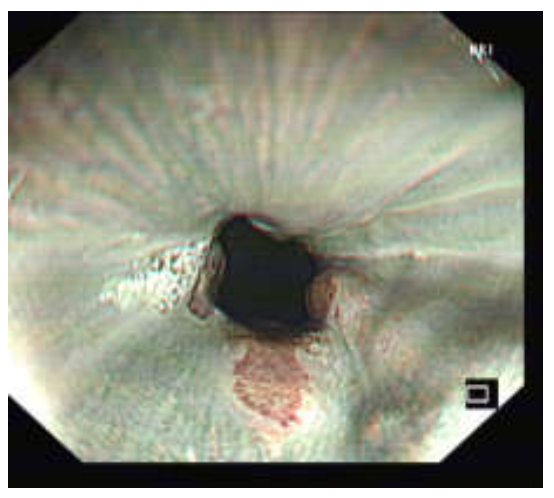 各种各样的胃镜贲门图