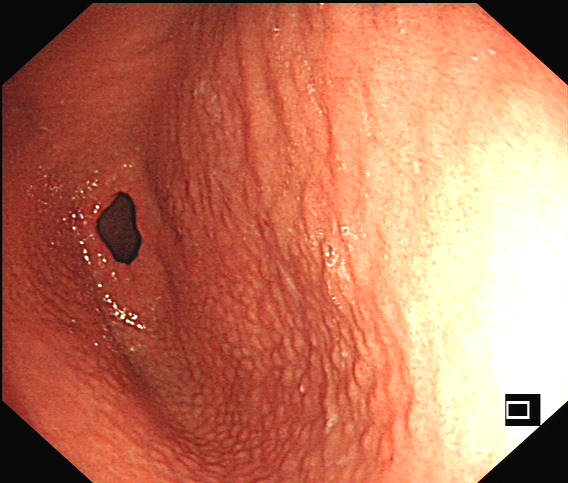 幽门螺旋杆菌感染相关胃炎胃镜下表现