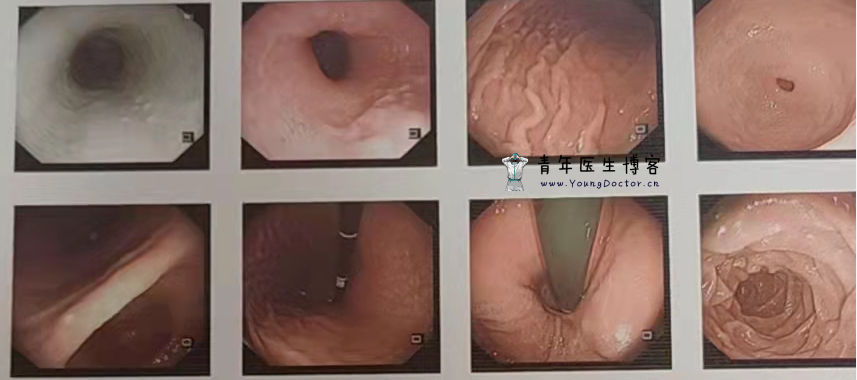 吞咽困难患者1例