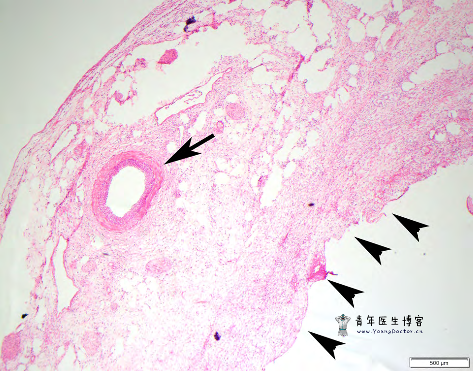 黏膜下恒径动脉破裂出血（Dieulafoy病）